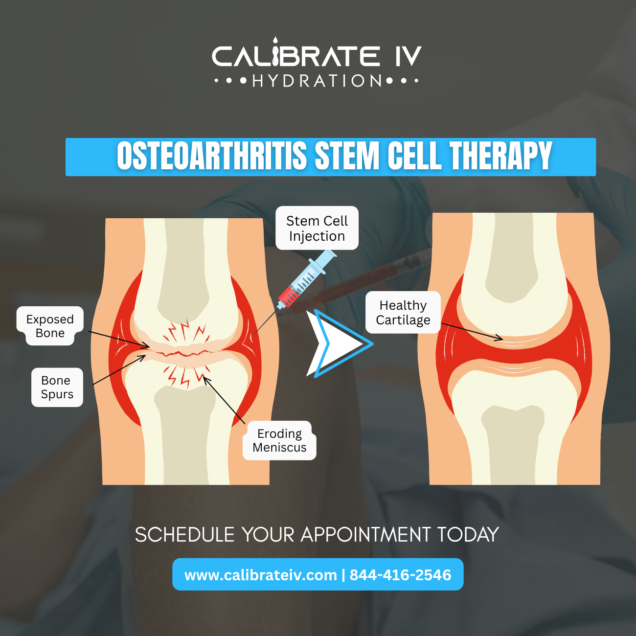 Regenerating Joint Health: How Stem Cell Therapy Supports Osteoarthritis Relief